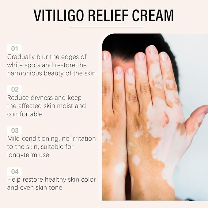 Vitiligo Removal Cream