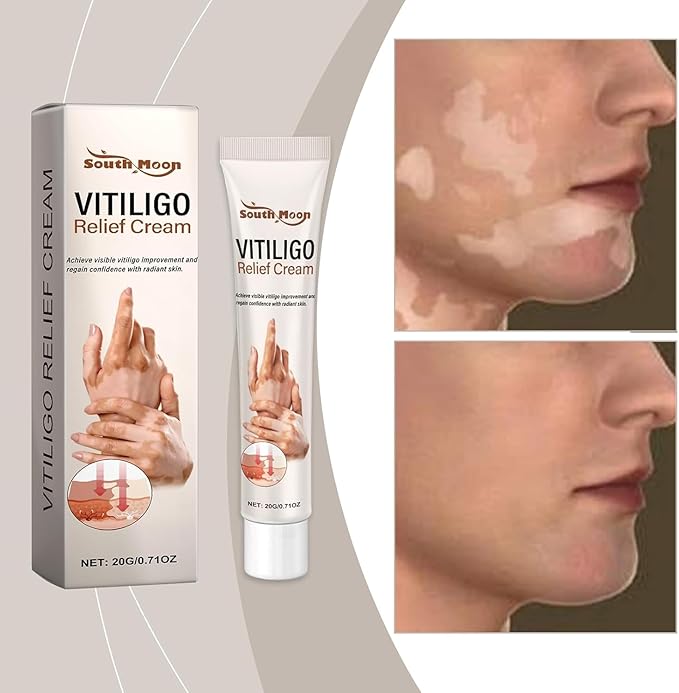 Vitiligo Removal Cream