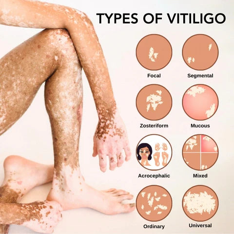Vitiligo Removal Cream