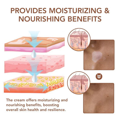 Vitiligo Removal Cream